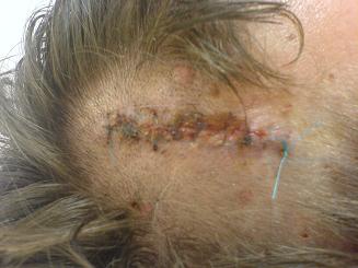 Shaved and stitched.. all in a weekend's fun.. 